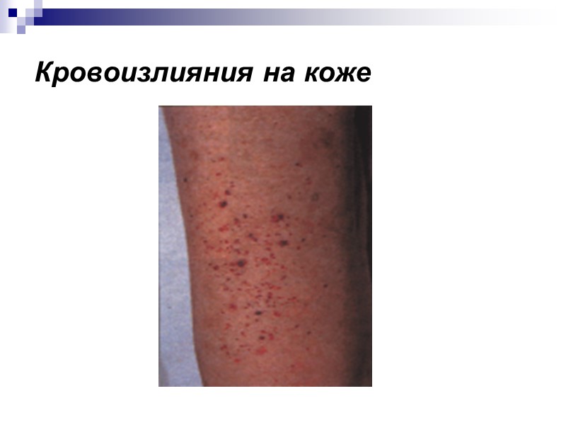 Кровоизлияния на коже